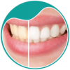 botao-A-clareamento-odontologia-estetica-do-sorriso-dra-sandra-vicente-barra-da-tijuca-clinica-faceortoto
