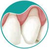 botao-A-enxerto-gengival-cirurgia-endodontia-odontologia-dentaria-dra-sandra-vicente-barra-da-tijuca-clinica-faceortoto-ortodontia-invisalign-aparelhos-invisiveis2