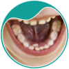 botao-A-frenecomia-lingual-e-labial-dra-sandra-vicente-barra-da-tijuca-clinica-faceortoto-ortodontia-invisalign-aparelhos-invisiveis2