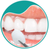 botao-A-lente-de-contato-odontologica-odontologia-estetica-planejamento-do-sorriso-dra-sandra-vicente-barra-da-tijuca-clinica-faceortoto-ortodontia-casa-shopping